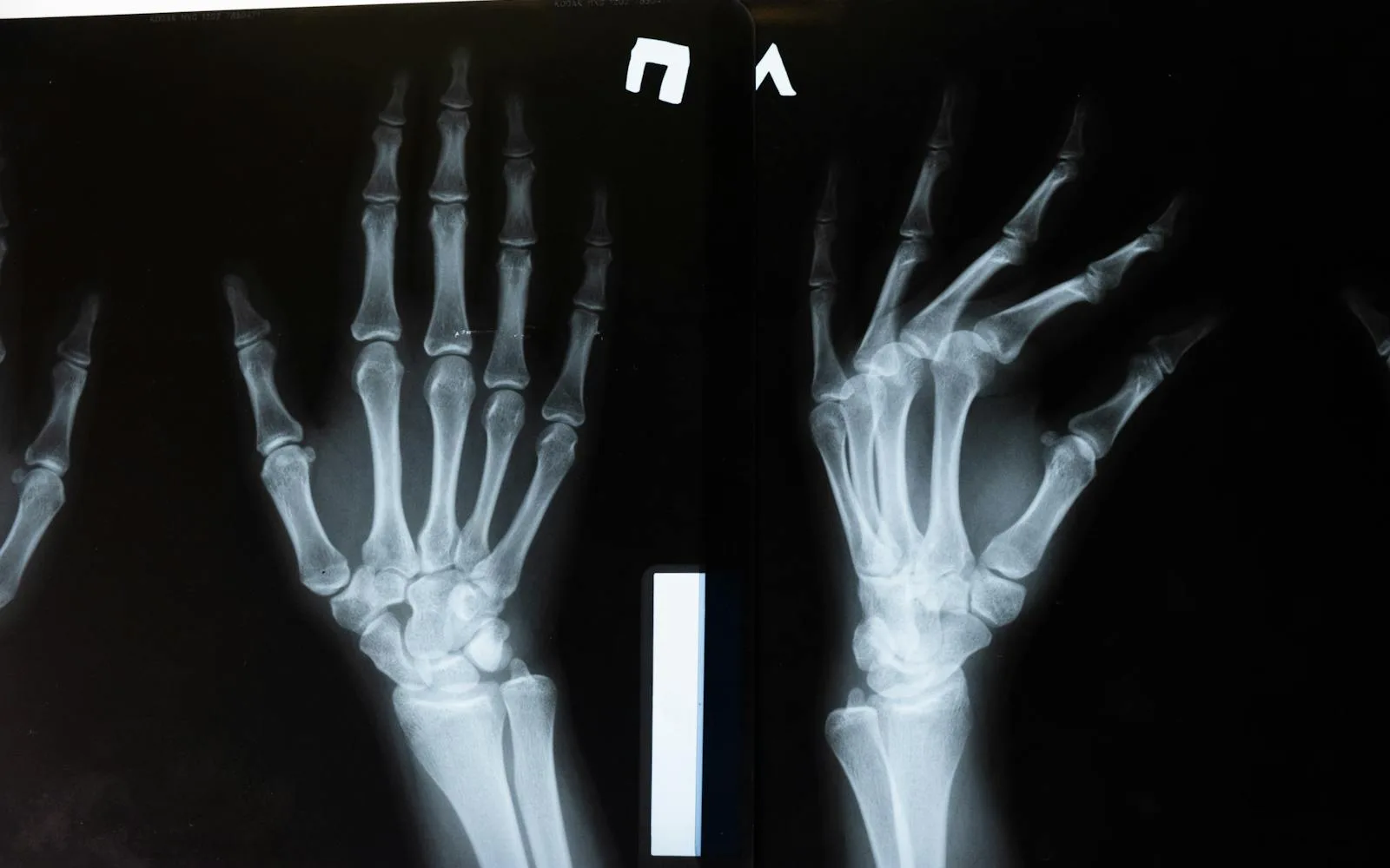 Bone Density (DEXA) Reading